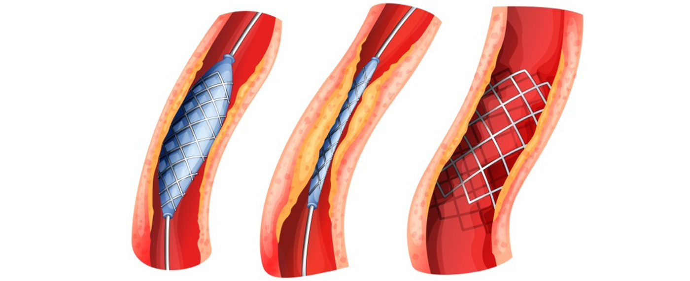 Obstrução Arterial